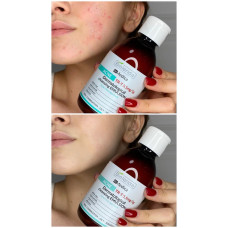 Набір для проблемної шкіри Bielenda Dr Medica Acne: емульсія, тонік, крем, сироватка