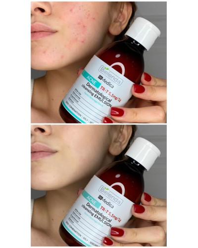 Набір для проблемної шкіри Bielenda Dr Medica Acne: емульсія, тонік, крем, сироватка