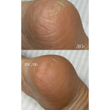 Гель-кератолітик для видалення загрубілої шкіри та натоптнів Mr.Scrubber Foot Professional Care