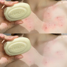 Мило від акне Perolite Benzoyl Peroxide