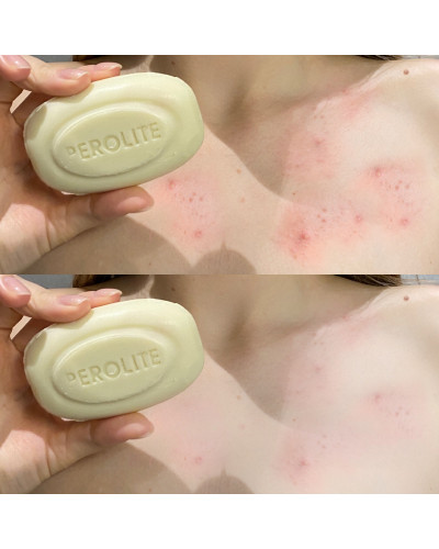 Мило від акне Perolite Benzoyl Peroxide